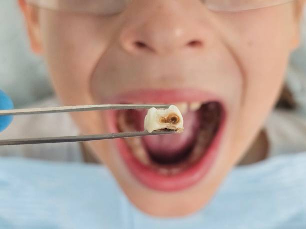 Best Emergency Dental Care for Broken or Chipped Teeth in Wellington, TX